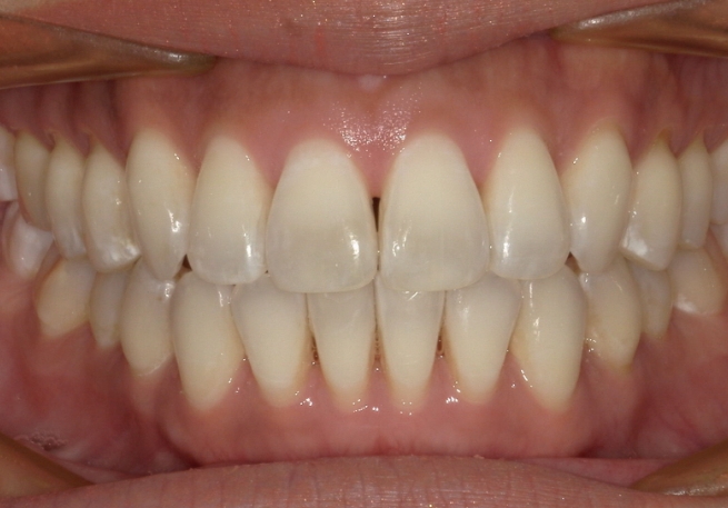 Close up of smile after fixing open bite and crooked teeth