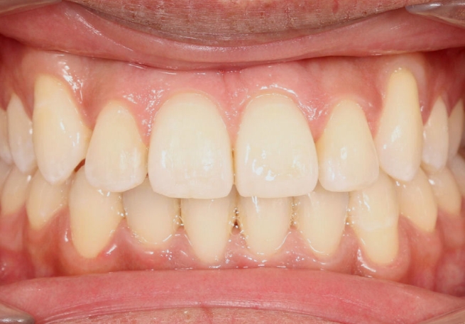 Mouth after correcting overcrowded teeth