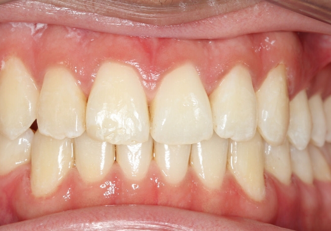 Mouth with both rows of aligned teeth