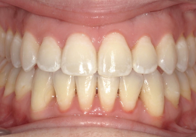 Mouth with two rows of well aligned teeth