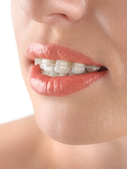 Close up of a person smiling with clear and ceramic braces in Fort Lauderdale