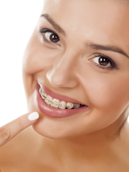 WOman with clear braces pointing to her smile