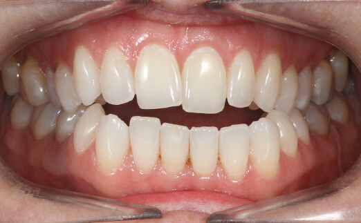Close up of smile with open bite and misaligned teeth