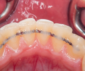 CLose up of retainer fixed behind row of lower teeth