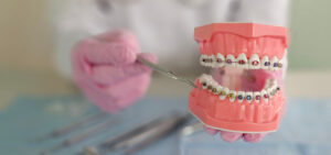 An orthodontist holding a model of teeth with braces while demonstrating the dental procedures.