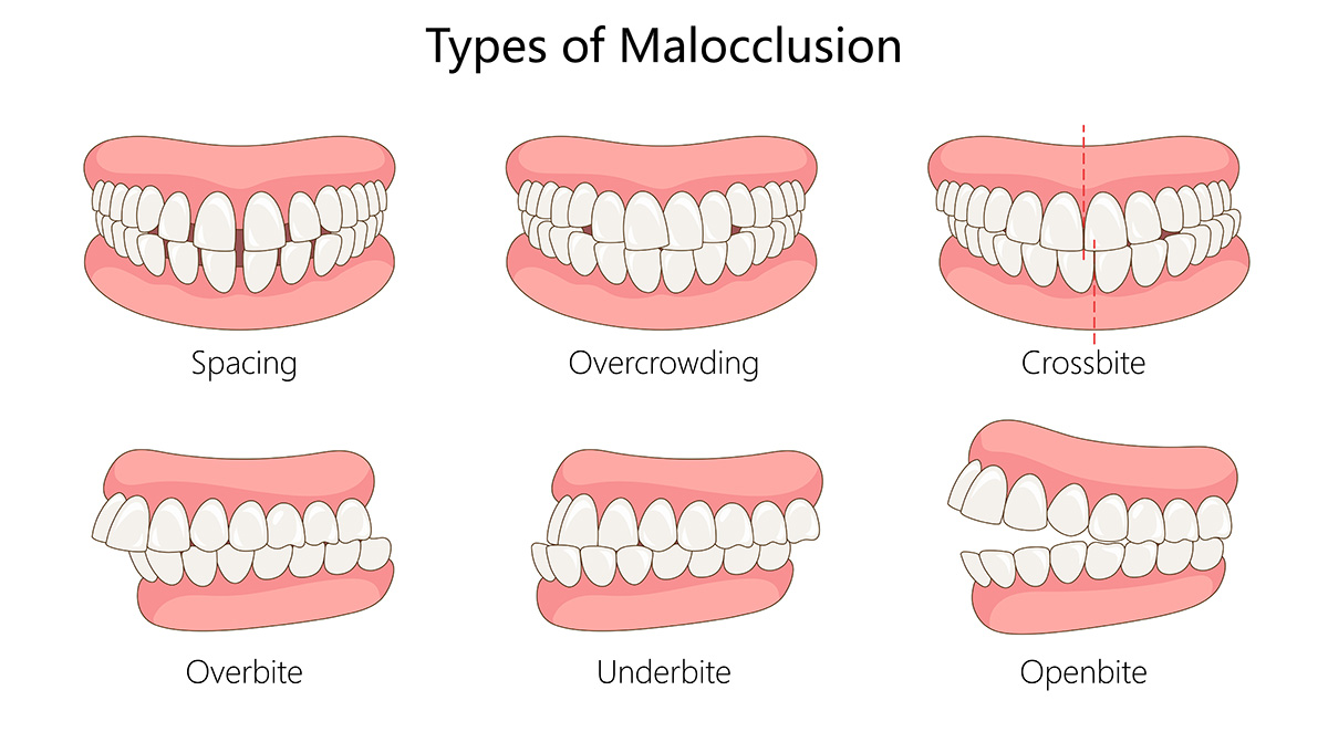 Types of Malocclusion