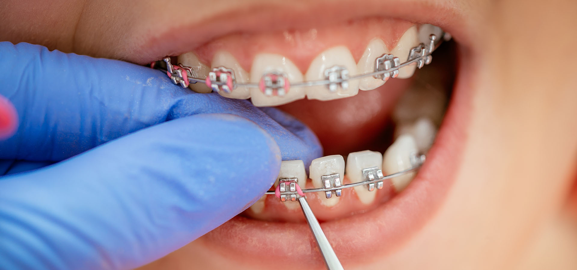 Patient with braces during orthodontic treatment