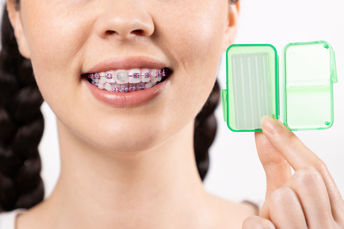 Close up of young woman with braces on teeth showing a little box with orthodontic wax.